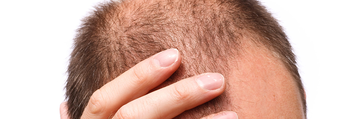 Questions About Hair Transplantation in Turkey