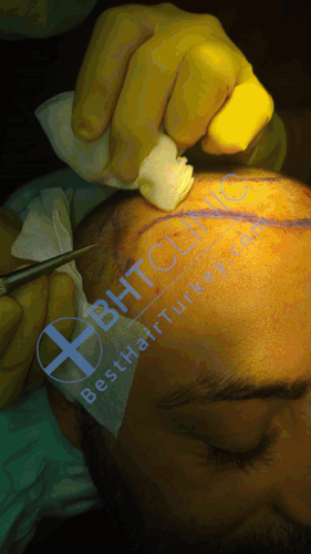 implanting grafts with a manual punch
